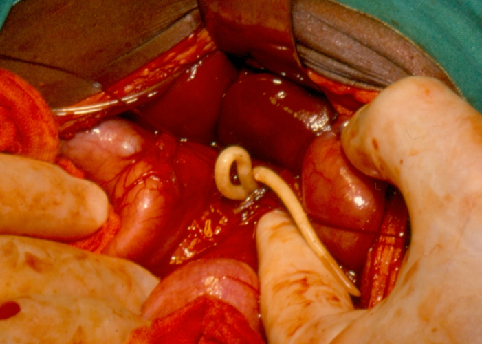 Soil-transmitted helminthiasis