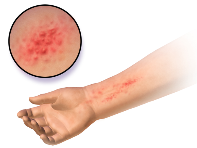 Sindrome da allergia sistemica al nichel