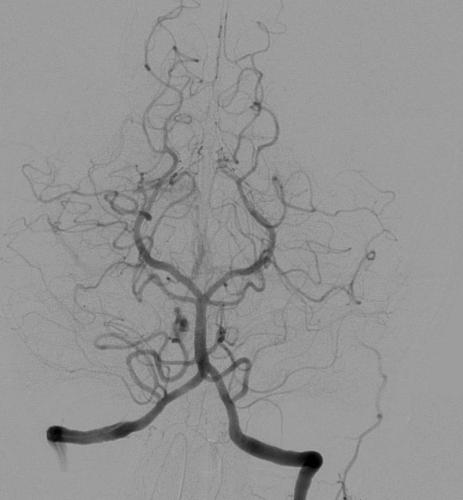 Angiografia