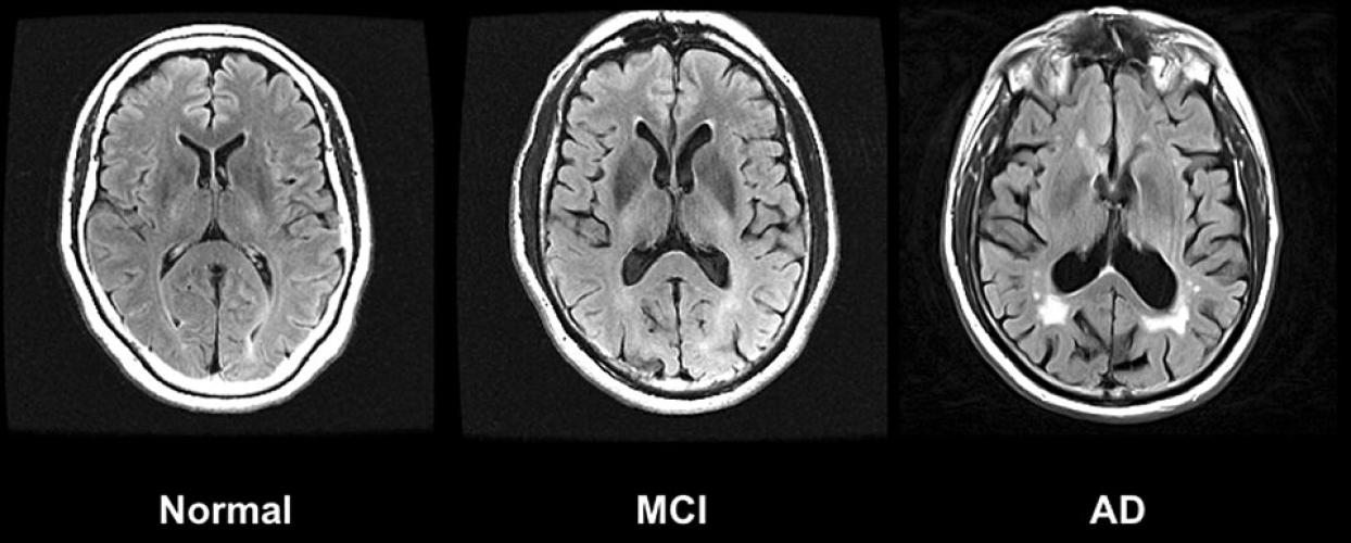 Choroba Alzheimera