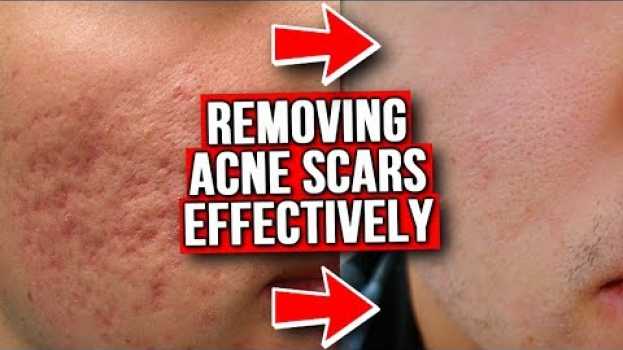 Video GET RID OF ACNE SCARS (FROM EXPERIENCE) in Deutsch