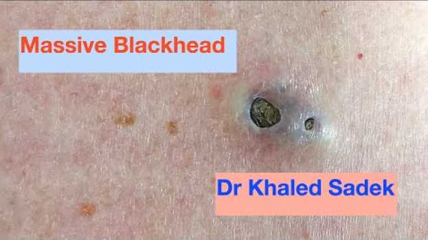 Video Massive 3 year old Blackhead finally comes out. Dr Khaled Sadek. LipomaCyst.com su italiano
