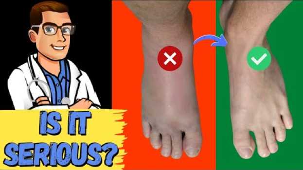 Video How To Tell If My Foot or Ankle Injury is BAD! [Sprained or BROKEN?] su italiano