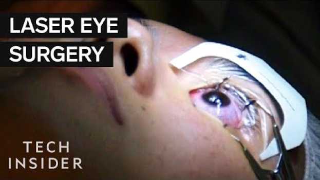 Video What It's Like To Get Laser Eye Surgery em Portuguese