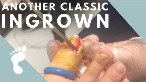 Video You guessed it... ANOTHER INGROWN TOENAIL! in English