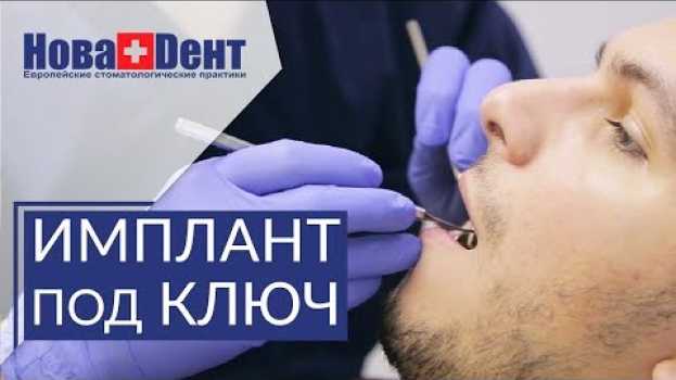 Video 🔑  Что включает в себя имплантация зубов под ключ. Имплантация зубов под ключ. НоваДент. 12+ su italiano