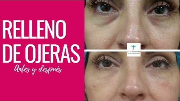 Video Rellenos Faciales Para Ojeras en Mujeres de 40 años y más | Cuarentonas y Felices in English
