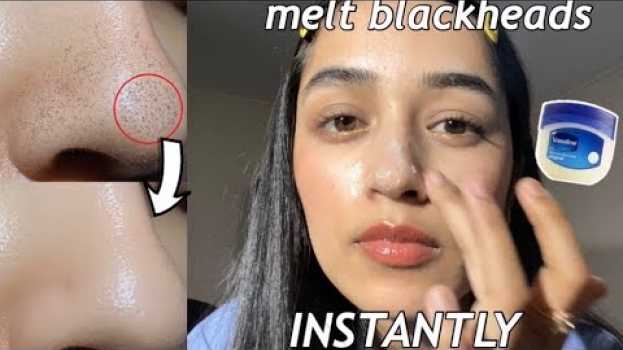 Video I removed my blackheads INSTANTLY w/ VASELINE + OIL! | How to get rid of blackheads in Deutsch