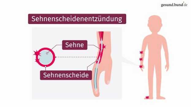 Video Was ist eine Sehnenscheidenentzündung? in Deutsch