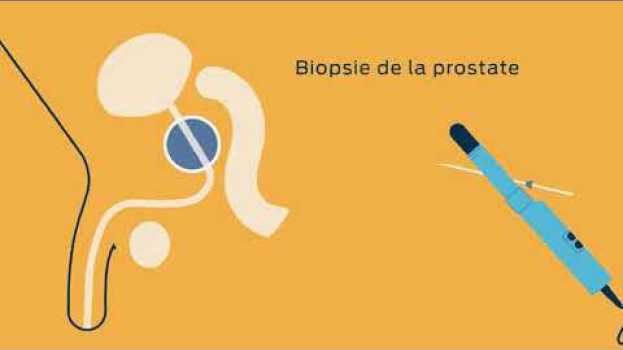 Видео Les examens pour diagnostiquer et surveiller le cancer de la prostate на русском