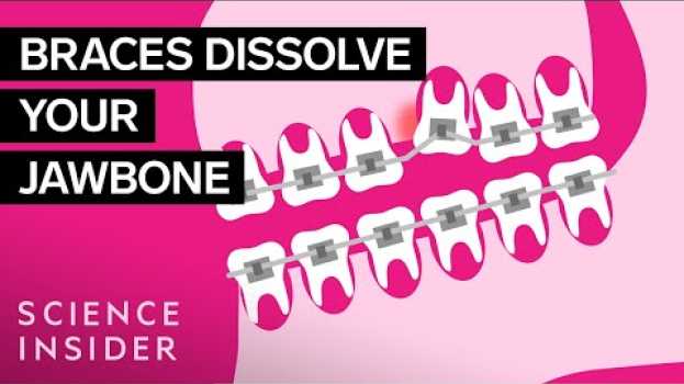 Video How Do Braces Actually Work? in English