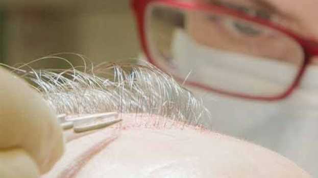 Video Haartransplantation Geheimratsecken und Glatze mit Vorher-Nachher Vergleich in einer OP su italiano