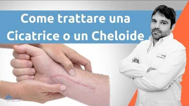Video Come trattare una cicatrice cheloide en Español