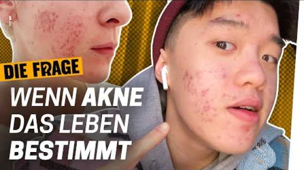 Видео Akne: Mehr als nur Pickel | Wie komme ich mit meinem Körper klar? Folge 5 на русском