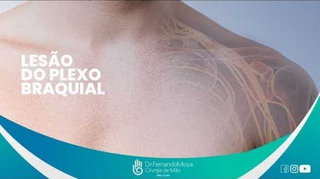 Video Lesões do plexo braquial: o que são, causas e tratamento | Dr. Fernando Moya CRM 112.046 en français
