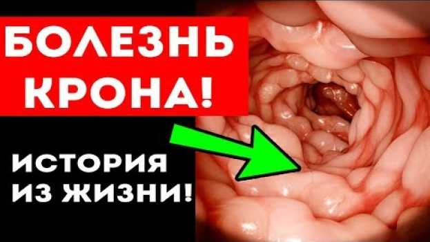 Видео Вот как ПИТАНИЕ ПОБЕДИЛО серьезный ДИАГНОЗ! Воспаление кишечника ВЗК (болезнь Крона) на русском