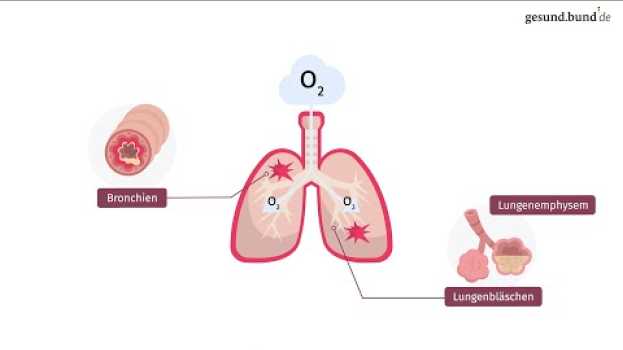 Video Was ist eine chronisch obstruktive Lungenerkrankung (COPD)? in English