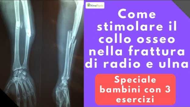 Видео Come stimolare il callo osseo nella frattura di radio e ulna (speciale bambini con 3 esercizi!!) на русском