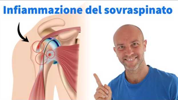 Video Risolvi l'infiammazione del SOVRASPINATO con questi semplici esercizi su italiano