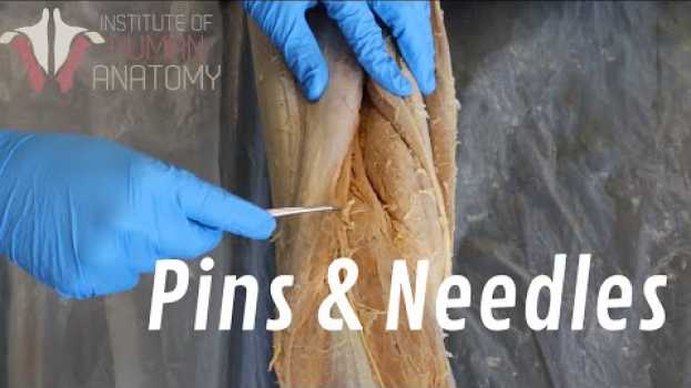 Video What Are "Pins & Needles"?? en Español