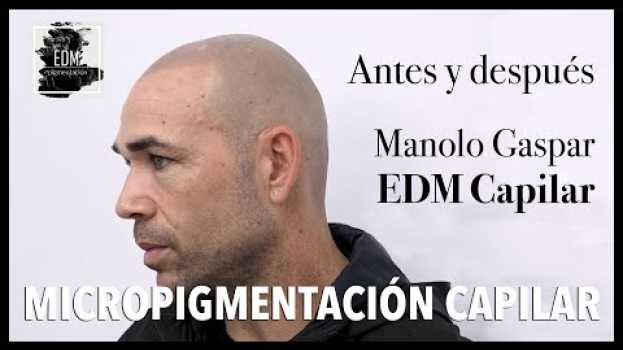 Video Manolo Gaspar, futbolista profesional - Antes y después de la micropigmentación capilar in English