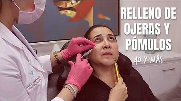 Video Relleno de Ojeras y Pómulos con ácido hialurónico | Mujeres de 40 años y más su italiano