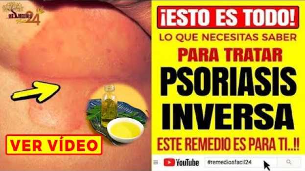 Video Esto es lo que Necesita Saber de la PSORIASIS INVERSA y Enterate de Estos Remedios Caseros en français