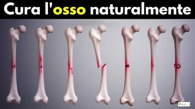 Video Come stimolare il callo osseo (per frattura non consolidata!) en français