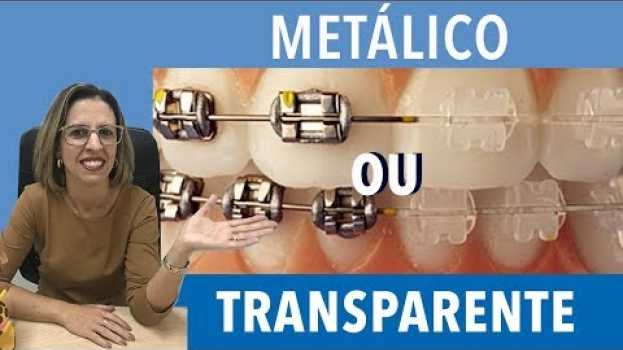 Video Diferença entre aparelho metal e transparente in English