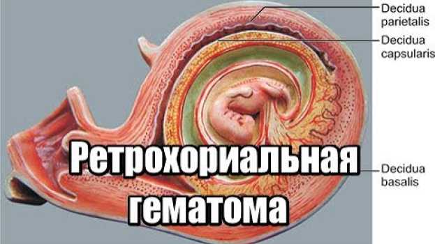 Видео Ретрохориальная гематома при беременности, выделения, гематома в матке, размер, лечение и причины на русском