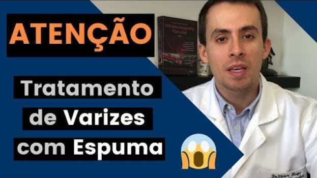 Video Tratamento de Varizes com Espuma: NÃO faça antes de ver esse vídeo. en Español