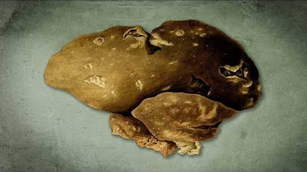 Video A Student Ate Leftover Potato Salad For Lunch. This Is What Happened To Her Liver. en français
