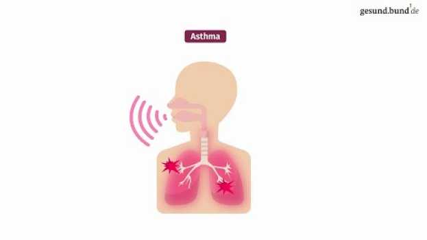 Video Was ist Asthma? in English