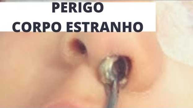 Video PERIGO de uma criança colocar algo no nariz e ouvido/ Dr. Paulo Mendes Jr - Otorrino em Curitiba en Español