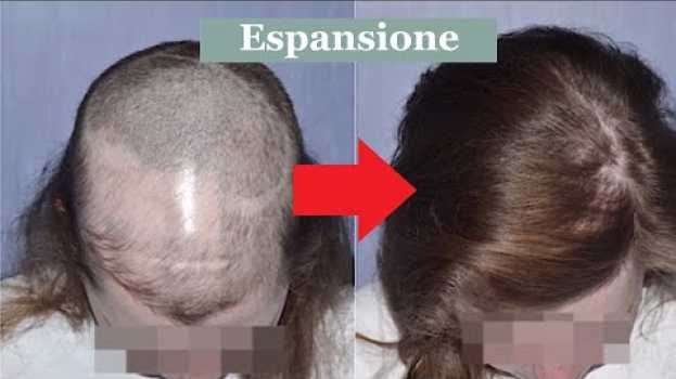 Video Cicatrici del cuoio capelluto ed alopecie: trapianto ed espansione cutanea su italiano