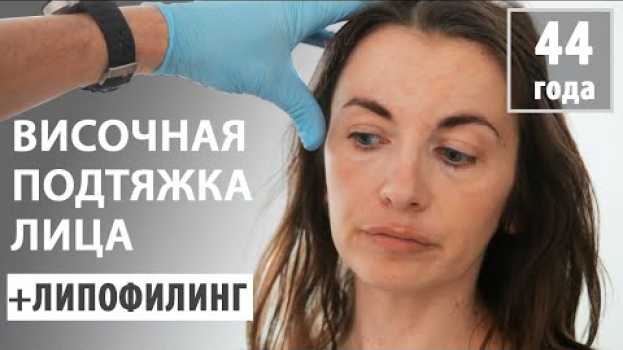 Video Подтяжка лица с липофилингом (пациентке 44 года) en français