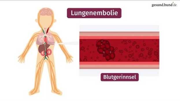 Video Was ist eine Lungenembolie? in English