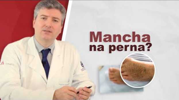 Видео Dermatite ocre. Tem como clarear as manchas nas pernas? на русском