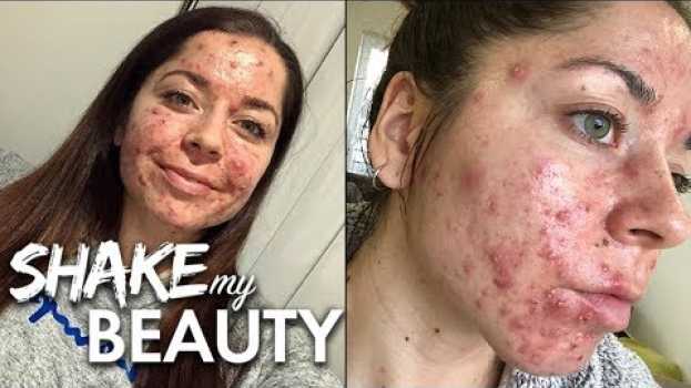 Видео Doctors Told Me I Had The Worst Acne They’d Ever Seen | SHAKE MY BEAUTY на русском