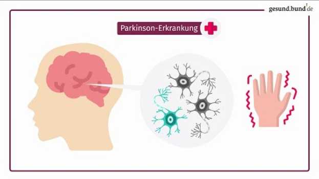 Video Was ist die Parkinson-Erkrankung? in English