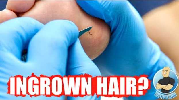Video INGROWN HAIR GROWING OUT OF HER FOOT?! su italiano